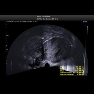 Ultraschallbild 1 Myom der Gebärmutter