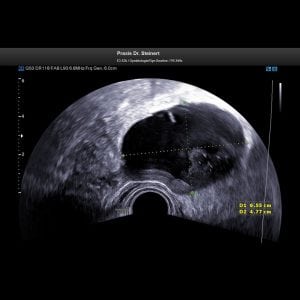 Ultraschallbild 2 gutartiger Tumor an den Eierstöcken