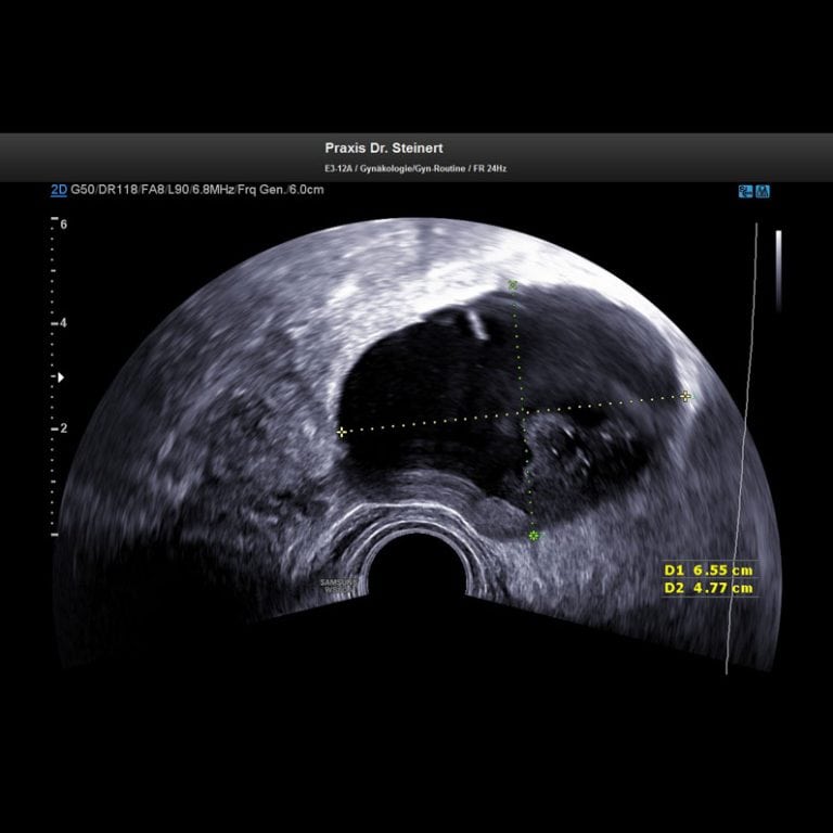 ultraschallbild2gutartigertumor Steinert Frauenärztin