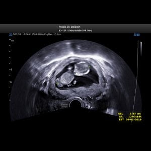 Ultraschallbild 7 Ultraschall in der Frühschwangerschaft